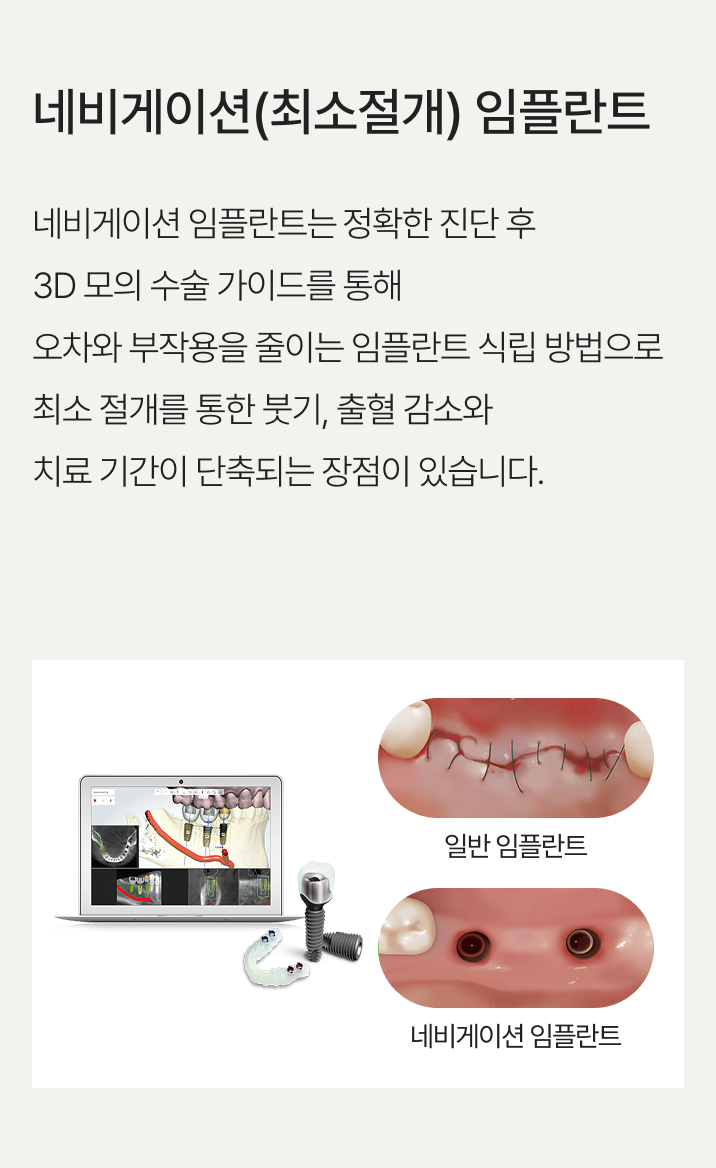 네비게이션(최소절개) 임플란트