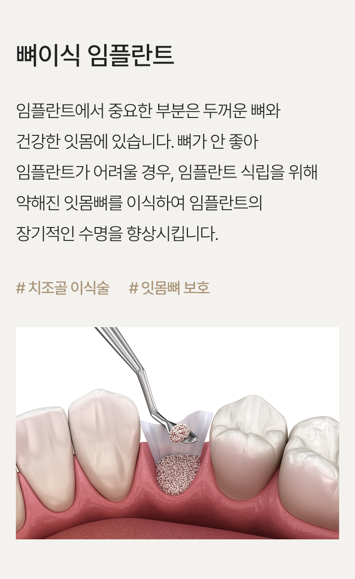 뼈이식 임플란트