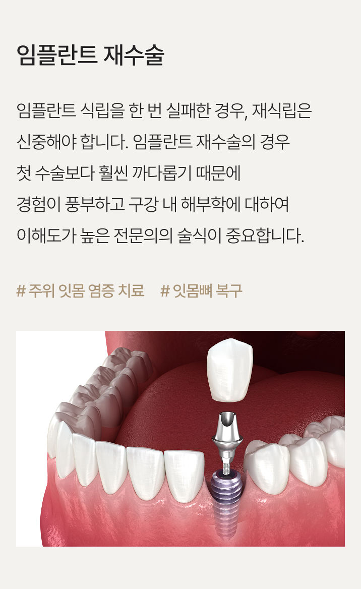 임플란트 재수술
