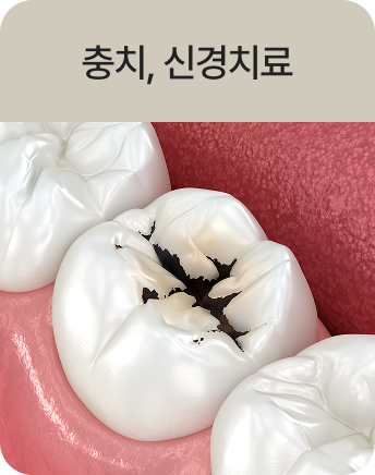 충치, 신경치료